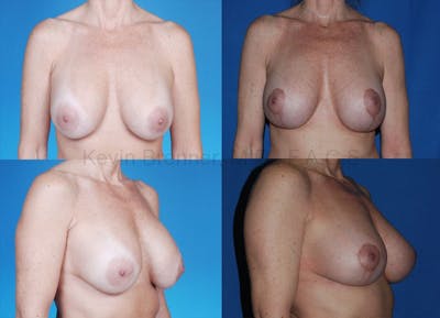 Breast Lift Before & After Gallery - Patient 1482333 - Image 1