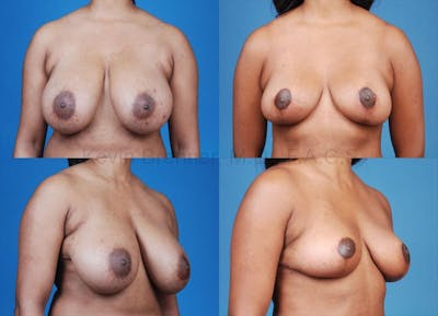 Breast Reduction Before & After Gallery - Patient 10131070 - Image 1