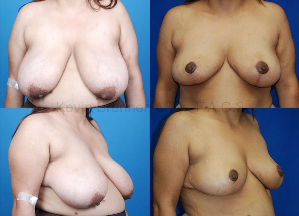 Breast reduction before and after 5