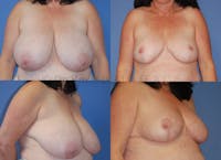 Breast Reduction Before & After Gallery - Patient 10131072 - Image 1