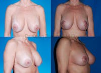 Breast Revision Surgery Before & After Gallery - Patient 1482338 - Image 1