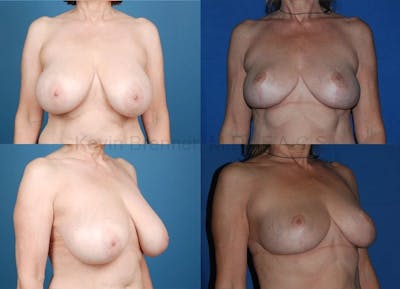 Breast reduction before and after 3
