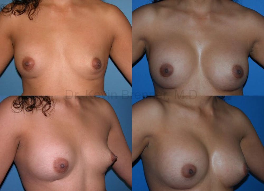 Breast revision before and after 4