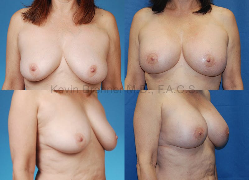 Breast revision before and after 1