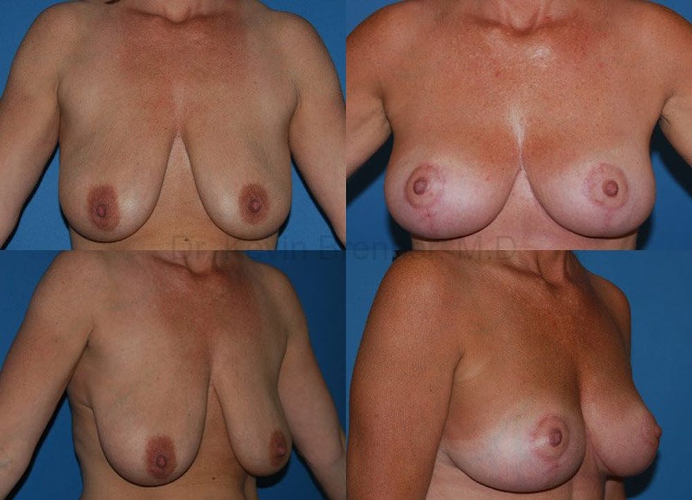 Breast Lift Gallery - Patient 1482351 - Image 1