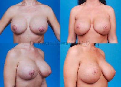 Breast Revision Surgery Before & After Gallery - Patient 1482353 - Image 1