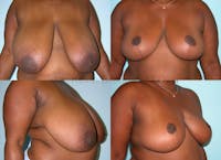 Breast Reduction Gallery - Patient 10131079 - Image 1
