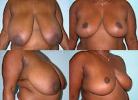 Breast Reduction Before & After Gallery - Patient 10131079 - Image 1