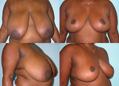 Breast Reduction Before & After Gallery - Patient 10131079 - Image 1