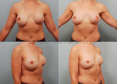 Breast Reconstruction Before & After Gallery - Patient 1482355 - Image 1