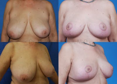 Breast Reduction Before & After Gallery - Patient 10131080 - Image 1