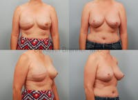 Breast Reconstruction Before & After Gallery - Patient 1482356 - Image 1