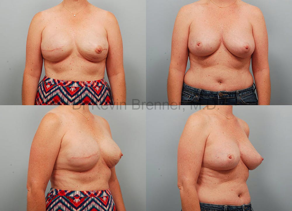 Breast Reconstruction Before & After Gallery - Patient 1482356 - Image 1
