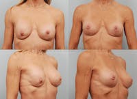 Breast Reconstruction Before & After Gallery - Patient 1482358 - Image 1