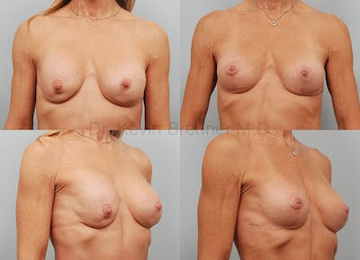 Breast Reconstruction Before & After Gallery - Patient 1482358 - Image 1