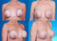 Breast Revision Surgery Before & After Gallery - Patient 1482359 - Image 1