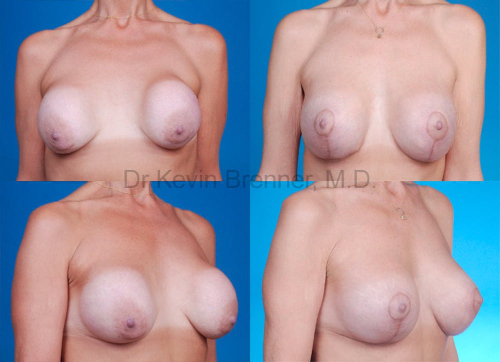 Breast Revision Surgery Before & After Gallery - Patient 1482359 - Image 1