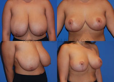Breast Reduction Before & After Gallery - Patient 10131083 - Image 1