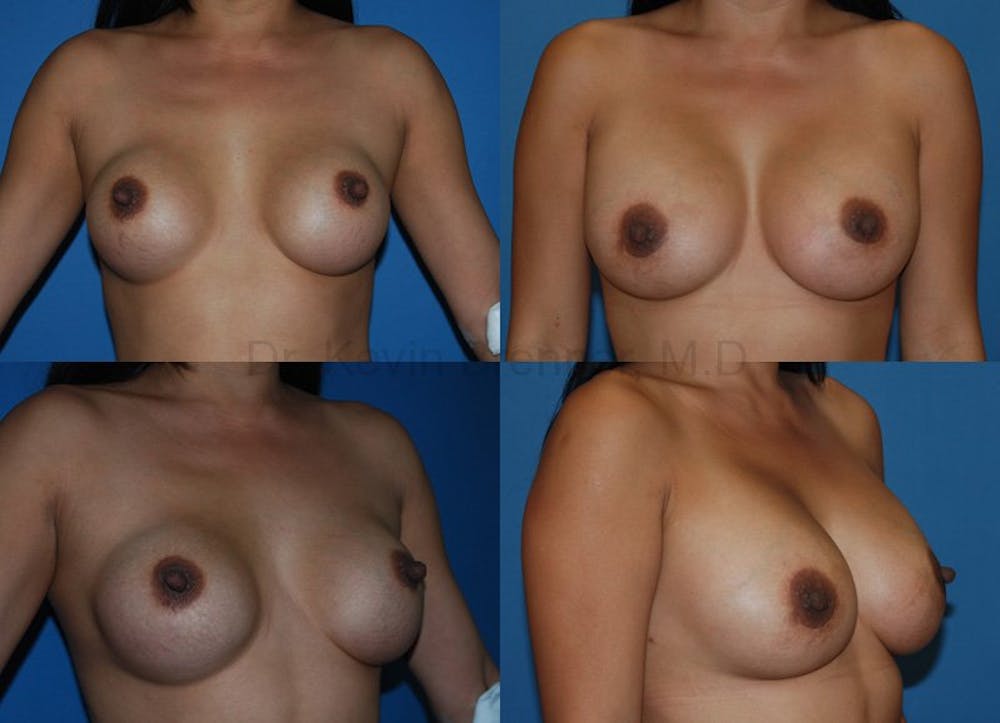 Breast Revision Surgery Before & After Gallery - Patient 1482366 - Image 1