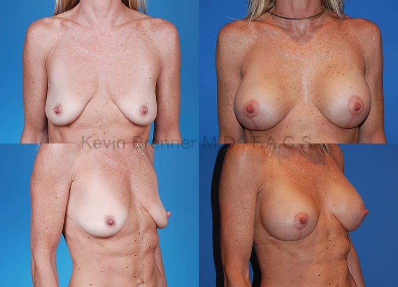 Breast lift before and after 4
