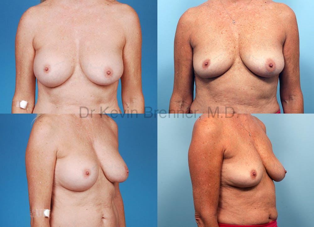 Breast Revision Surgery Before & After Gallery - Patient 1482370 - Image 1