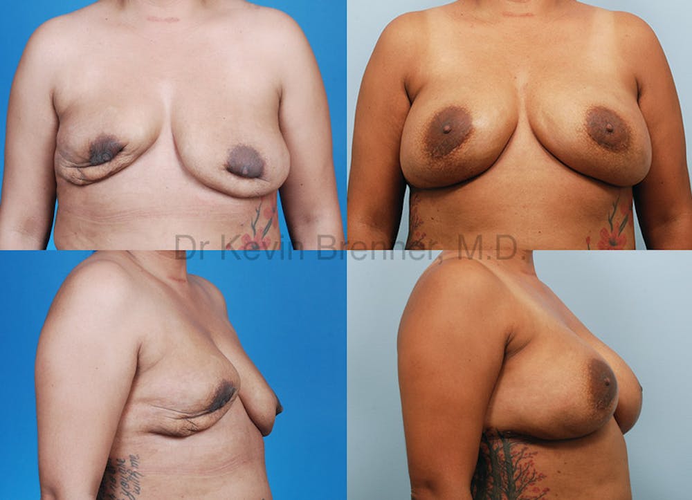 Breast Revision Surgery Before & After Gallery - Patient 1482373 - Image 1