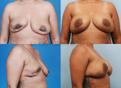 Breast Revision Surgery Before & After Gallery - Patient 1482373 - Image 1