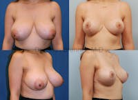 Breast Reduction Before & After Gallery - Patient 10131088 - Image 1