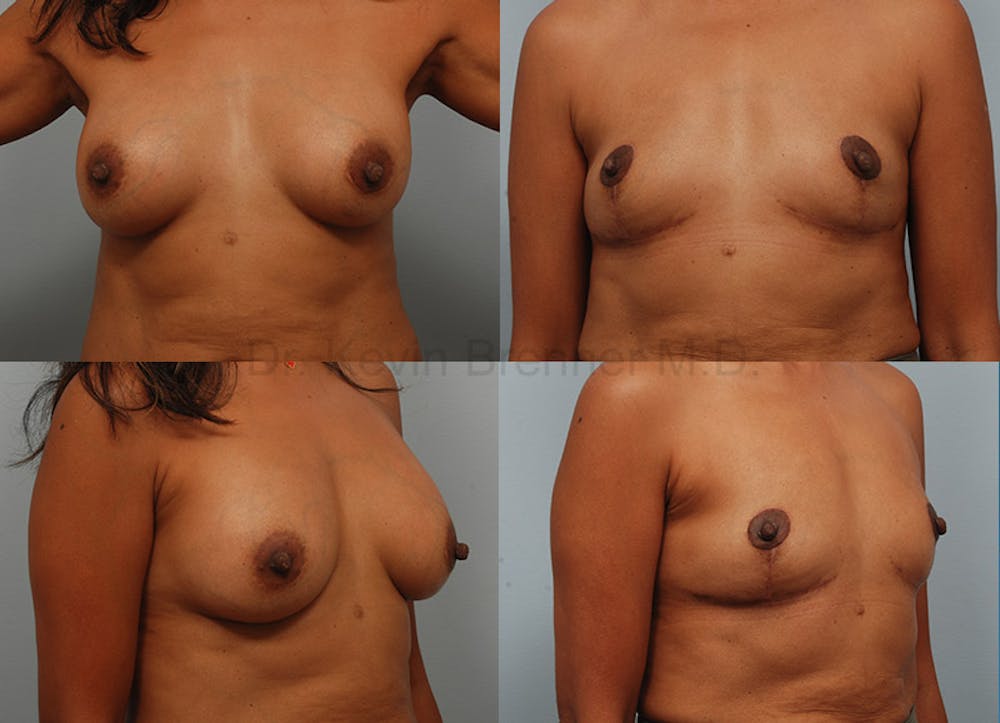 Breast Implant Removal Before & After Gallery - Patient 1482374 - Image 1