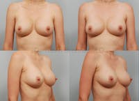 Breast Revision Surgery Before & After Gallery - Patient 1482376 - Image 1