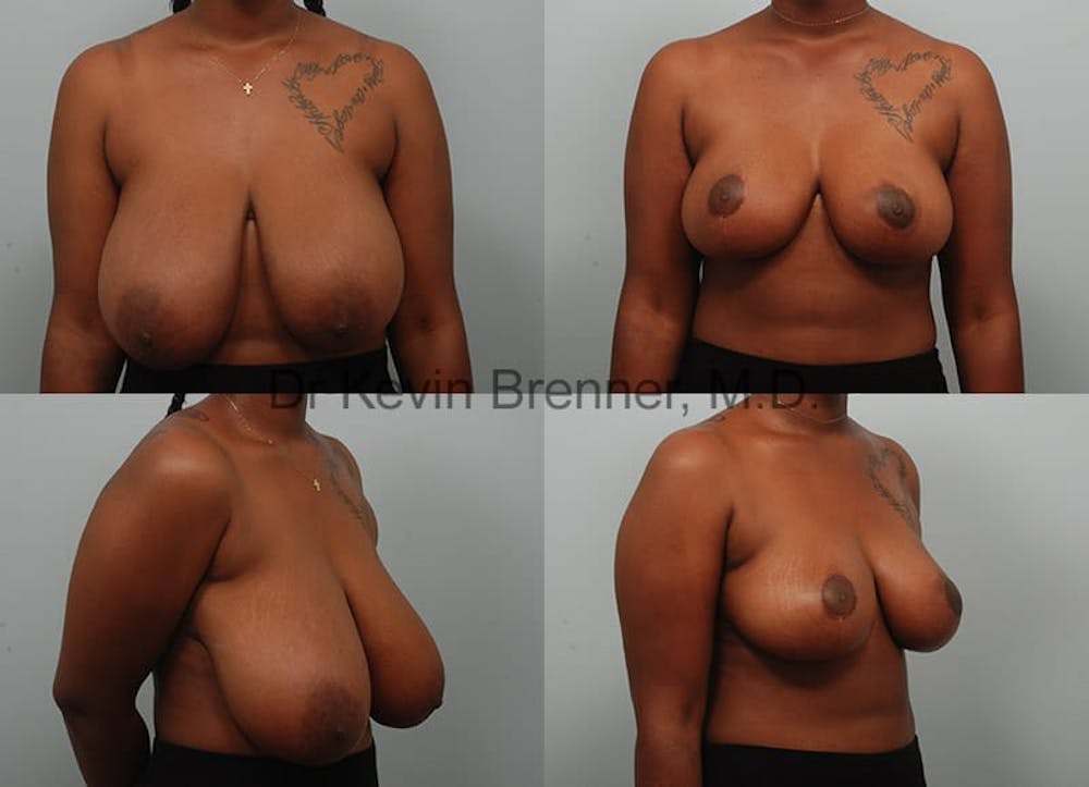 Breast Reduction Before & After Gallery - Patient 10131090 - Image 1