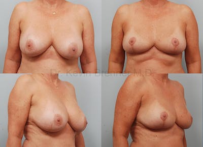 Breast Lift Before & After Gallery - Patient 350108 - Image 1