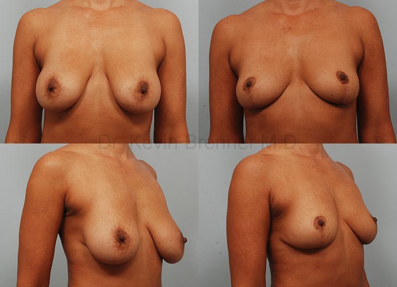 Beverly Hills Breast Lift results