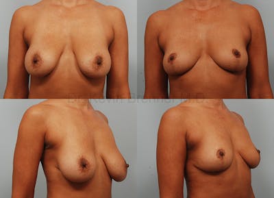 Breast Lift Before & After Gallery - Patient 1482383 - Image 1