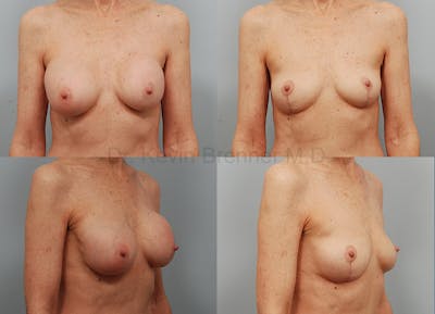 Breast Lift Before & After Gallery - Patient 297902 - Image 1