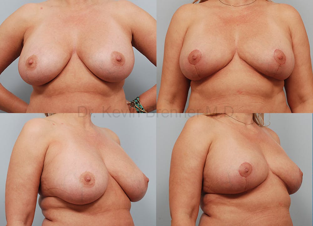 Breast Lift Before & After Gallery - Patient 647906 - Image 1