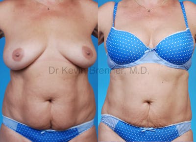 Liposuction Before & After Gallery - Patient 1482400 - Image 1