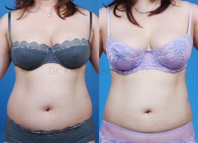 Liposuction Before & After Gallery - Patient 1482401 - Image 1