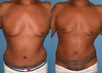 Liposuction Gallery - Patient 1482402 - Image 1