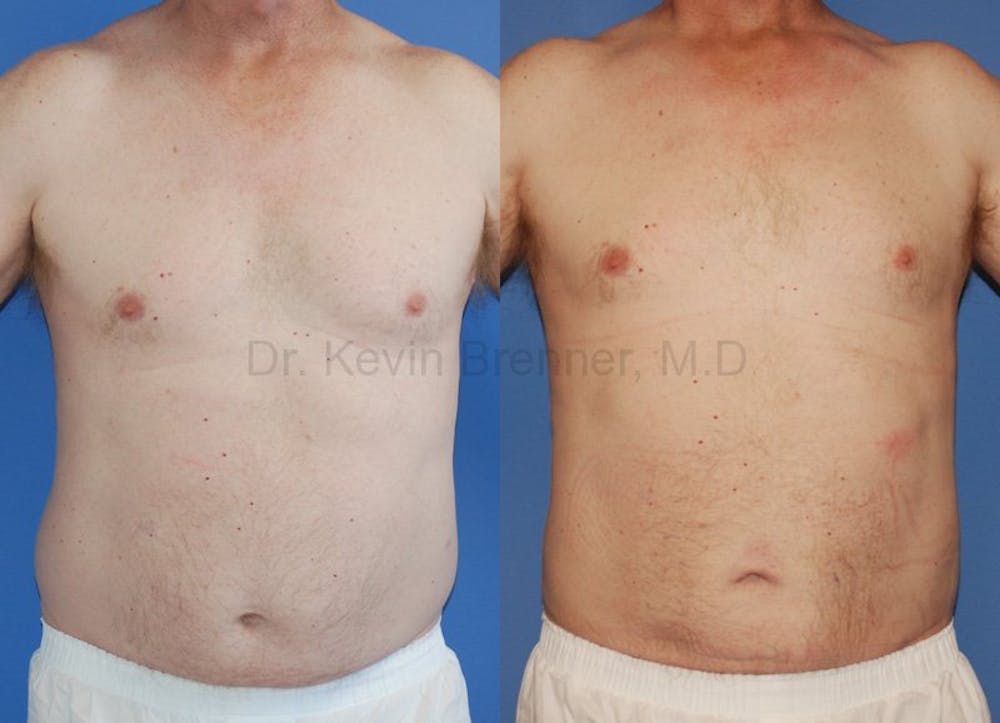 male liposuction patient results