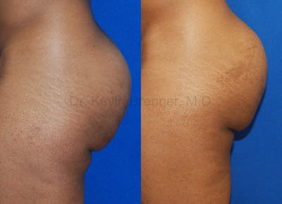 Liposuction Before & After Gallery - Patient 1482405 - Image 1
