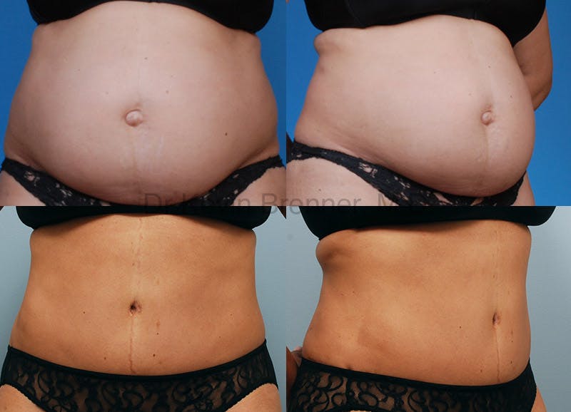 Before and after of tummy tuck in Beverly Hills 2