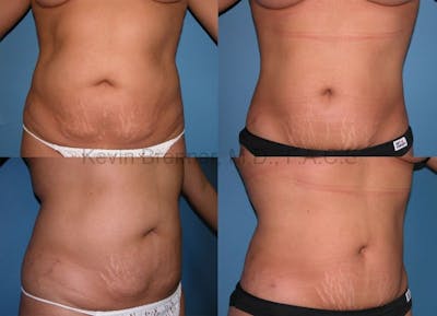 Liposuction Before & After Gallery - Patient 1482407 - Image 1