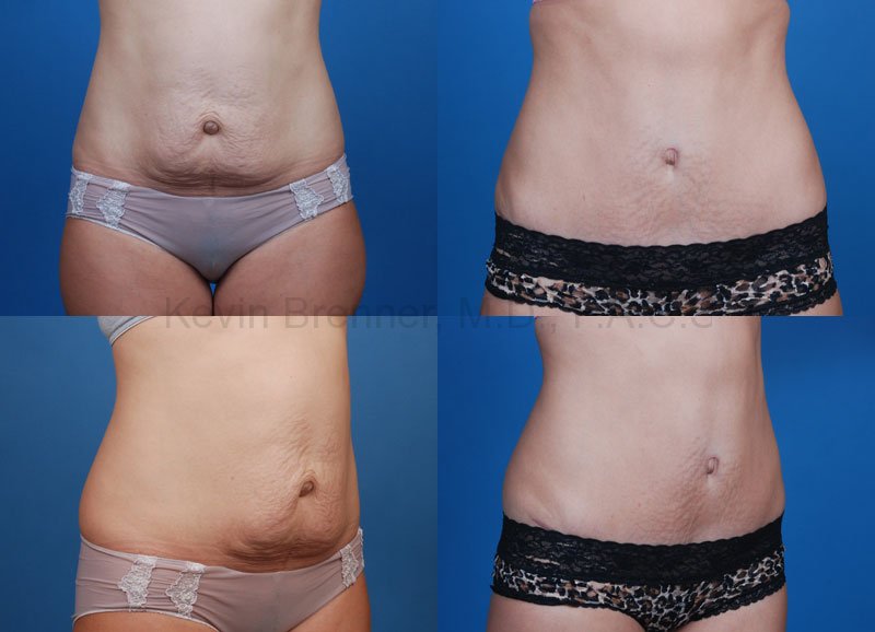 Results of a Tummy Tuck in Beverly Hills