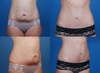 Before and after of tummy tuck in Beverly Hills 3