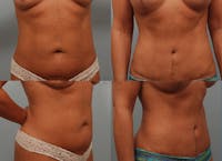Liposuction Before & After Gallery - Patient 1482412 - Image 1