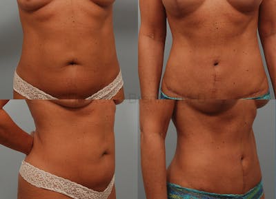 Liposuction Before & After Gallery - Patient 1482412 - Image 1