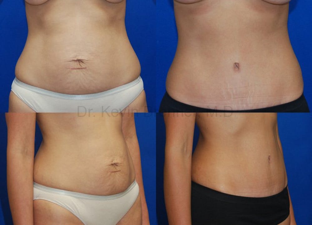 Tummy Tuck Before & After Gallery - Patient 1482409 - Image 1