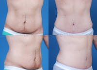 Body Contouring Before & After Gallery - Patient 1482410 - Image 1