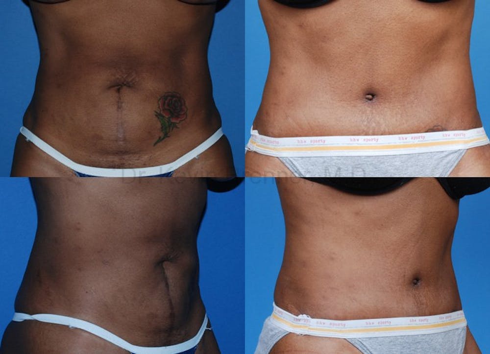 Tummy Tuck Before & After Gallery - Patient 1482411 - Image 1